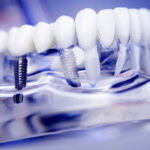 Dental Implants Care