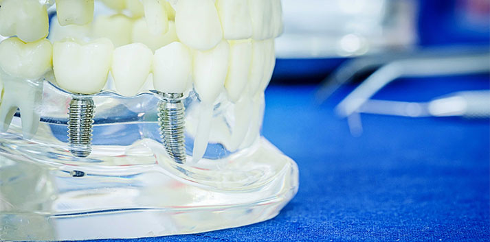 dental implants missing teeth solution