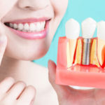Dental Implants Vs Dental Bridge
