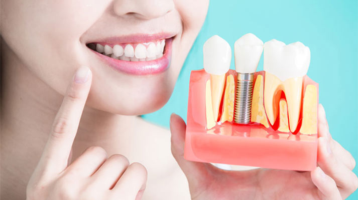 Dental Implants Vs Dental Bridge