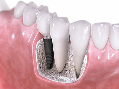 dental implants services