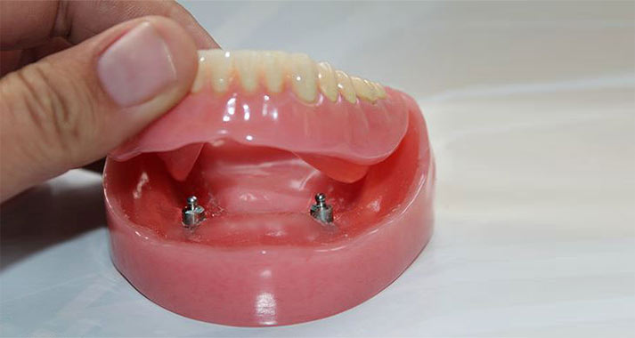 implant denture stabilization