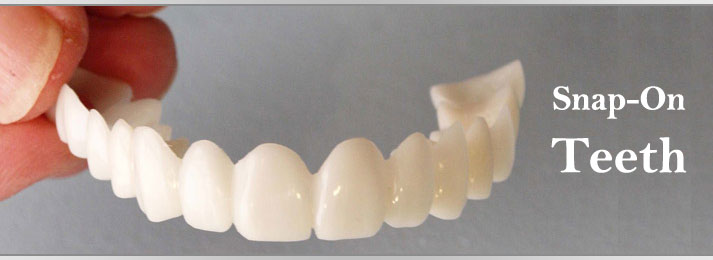 Snap On Teeth Ottawa