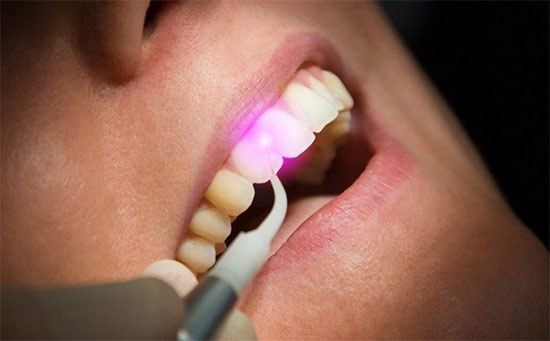 Soft Tissue Laser Therapy Dentistry