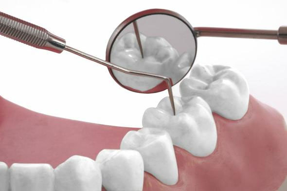 tooth white filling